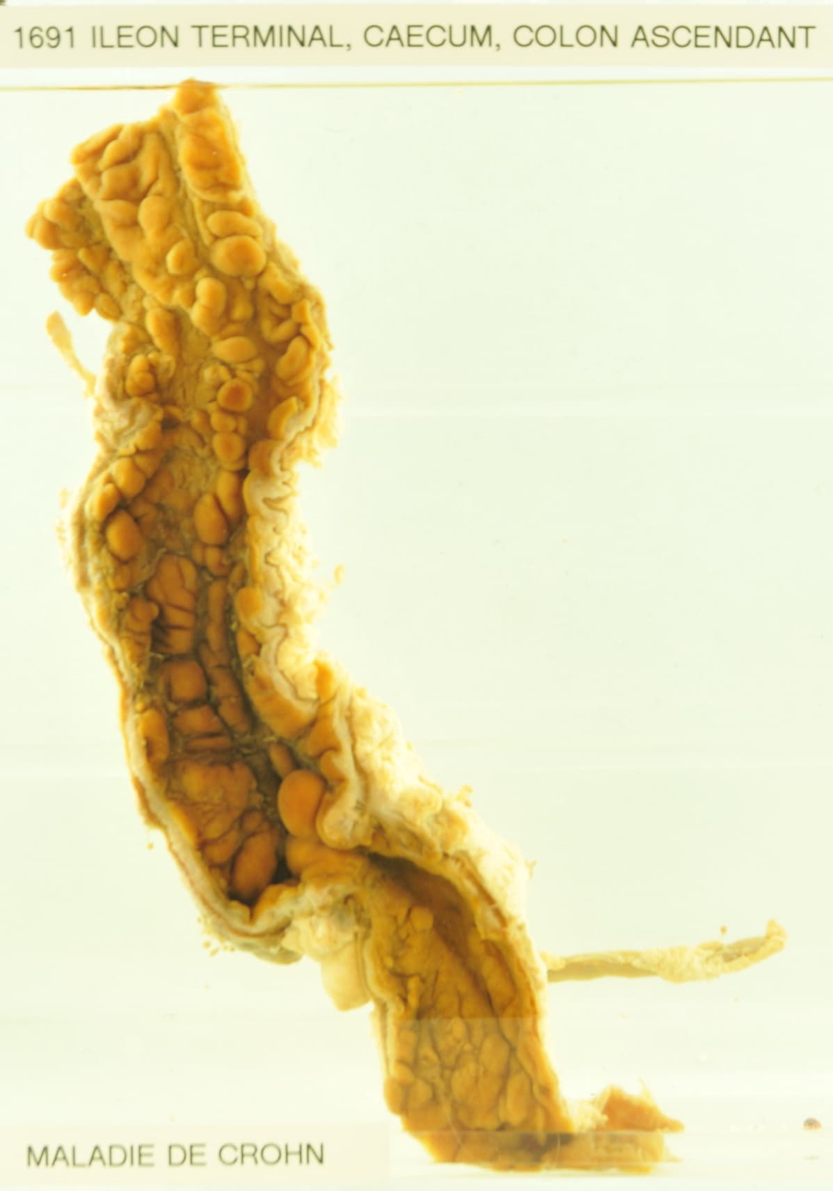 أسئلة شارحة: تحديات تشخيص وعلاج مرض كرون (Crohn's Disease)